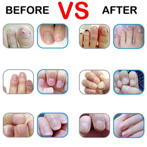 Nail Fungus Treatment