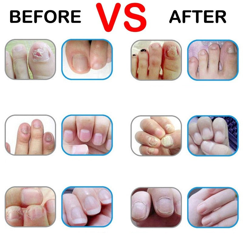 Nail Fungus Treatment